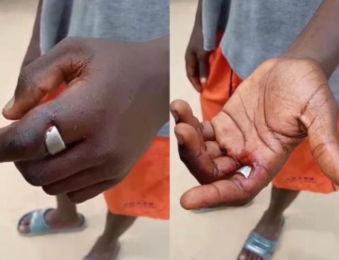 Teenager on verge of losing finger after wearing friend’s ‘sakawa’ ring