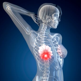 4,600 women affected with breast cancer, over 2,000 deaths recorded − Breast care advocate reveals