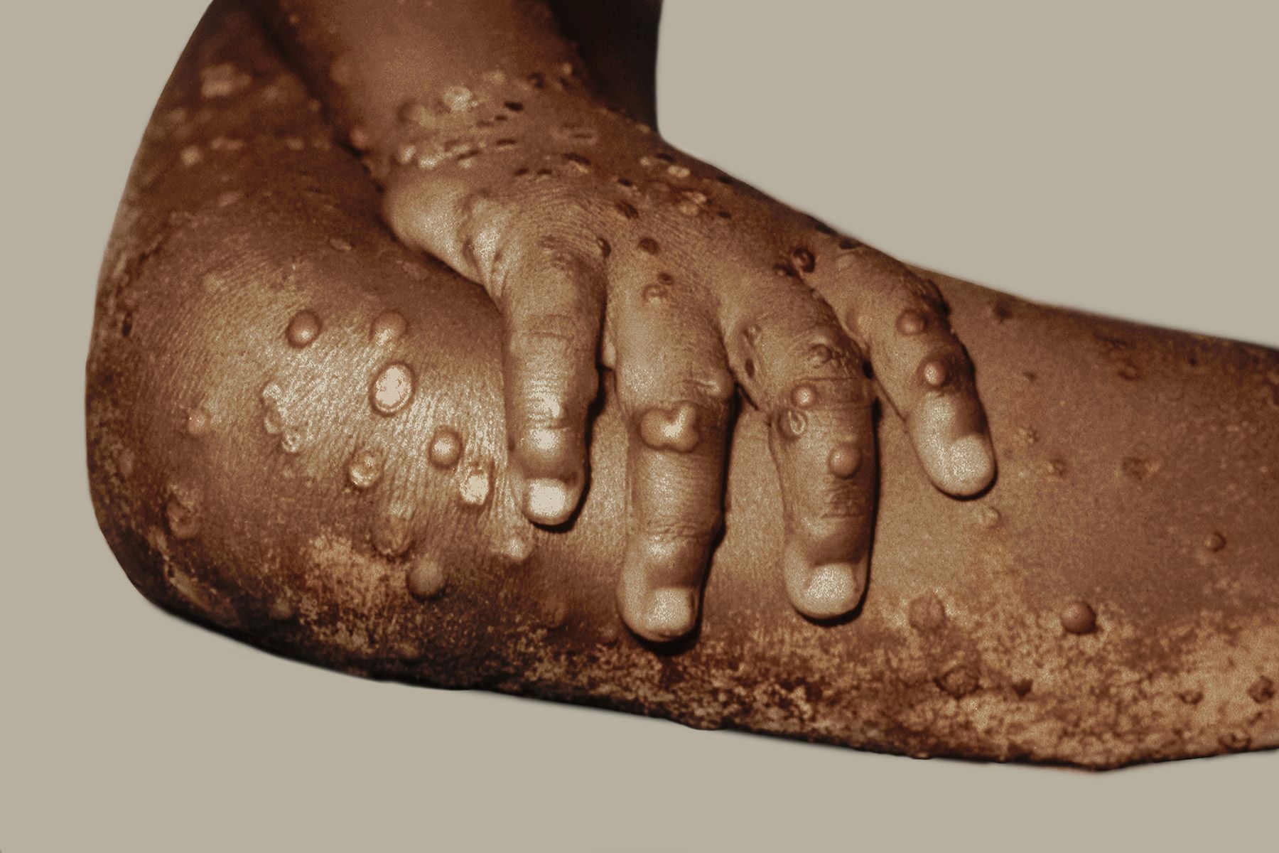 Ghana records five cases of Monkeypox – GHS