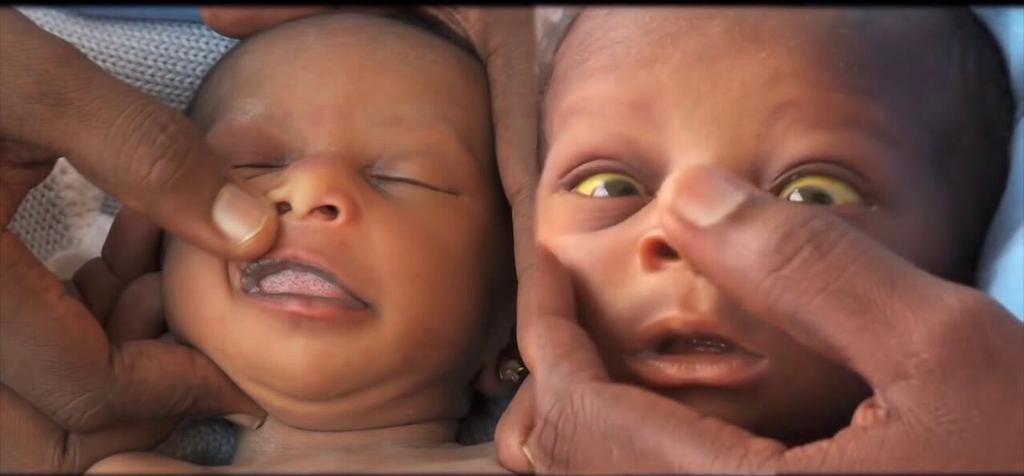 Juliana Dwamena writes: Prevalence of Neonatal Juandice in Ghana