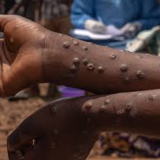 Ghana’s Mpox cases now surge to 79