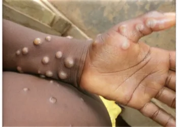 Ghana reports 12 new Mpox cases as total reaches 908