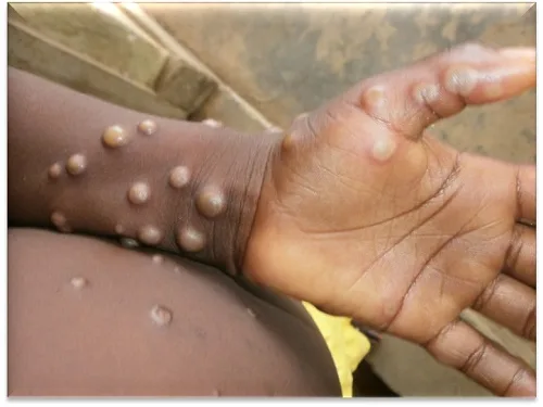 Ghana reports 12 new Mpox cases as total reaches 908