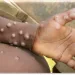 Ghana reports 12 new Mpox cases as total reaches 908