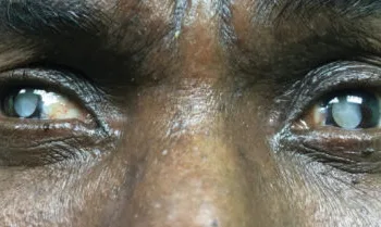 GHS marks world glaucoma week 2026: Calls for eye screening to prevent irreversible blindness