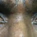 GHS marks world glaucoma week 2026: Calls for eye screening to prevent irreversible blindness