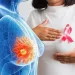 Breast screening included in Free Primary Healthcare package – NHIA