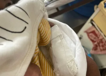 The baby's hand after the surgery