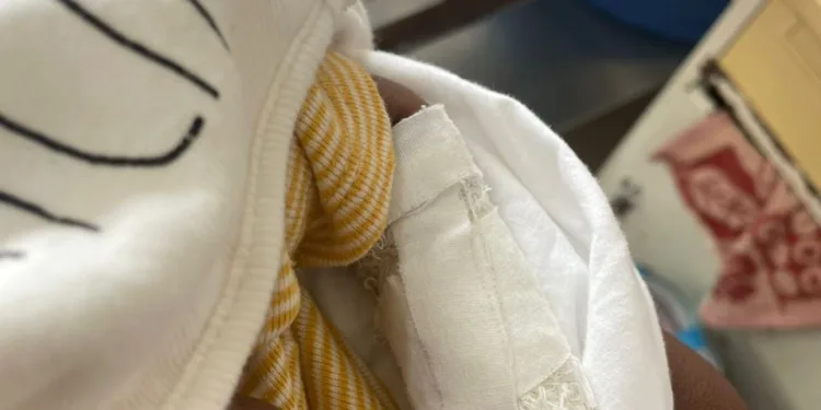 The baby's hand after the surgery